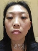 广州美莱整形医院价目表|罗延平隆鼻案例术后过程分享~ width=