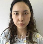 钟爱梅双眼皮全切前后过程分享|内附协和医院美容科价目表~ width=