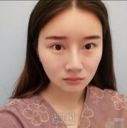 重庆华美整形价目表|内附潘宝华颧骨内推术后恢复分享~ width=