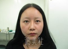 毕洪森面部吸脂案例：从此拥有瓜子脸~ width=