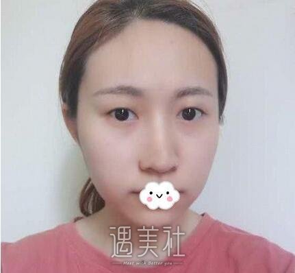 西京,张辉,双眼皮