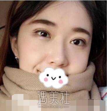 华西,卿勇,双眼皮