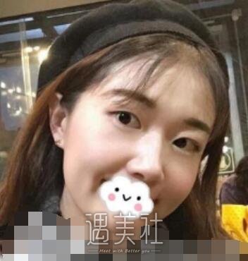 华西,卿勇,双眼皮