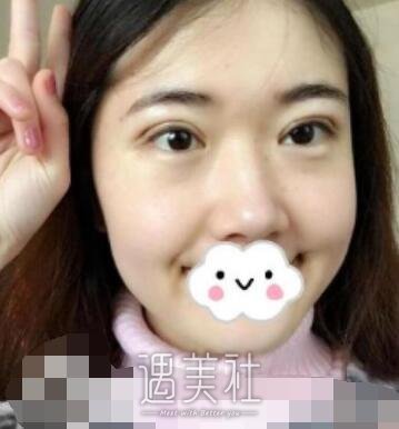 华西,卿勇,双眼皮