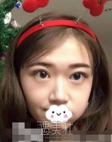 华西,卿勇,双眼皮