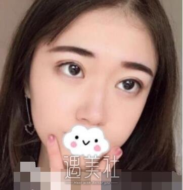 华西,卿勇,双眼皮