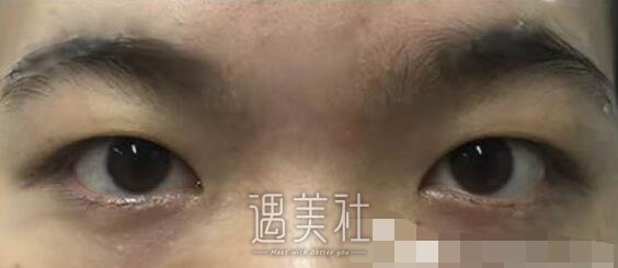 王晋煌,双眼皮