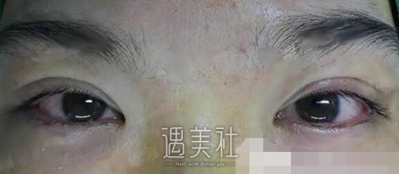 王晋煌,双眼皮