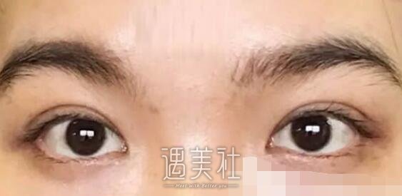 王晋煌,双眼皮