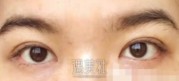 王晋煌,双眼皮