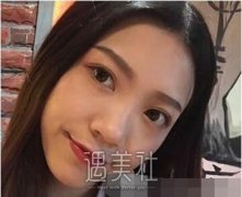 李战强做鼻子的特点是怎样的？案例来说明~ width=