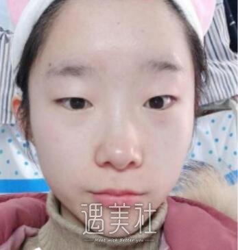 八大处,杨明勇,双眼皮