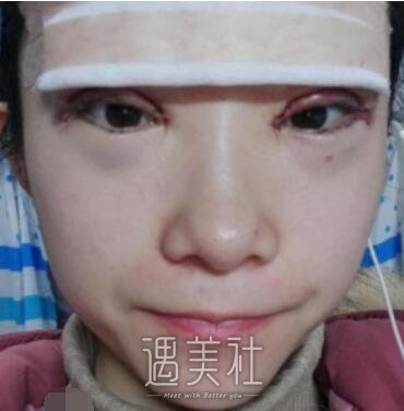 八大处,杨明勇,双眼皮