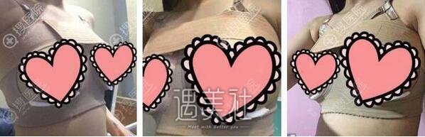 假体隆胸