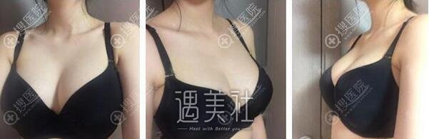 假体隆胸