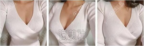 假体隆胸