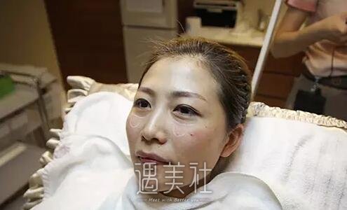 泪沟填充前后对比照片|泪沟填充真实全纪录~