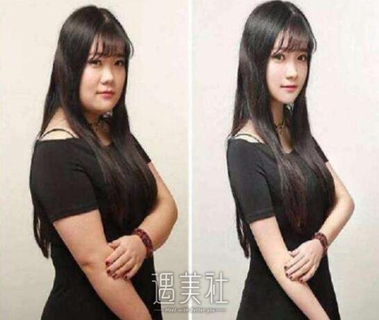 上海九院抽脂手术价格是多少?贵不贵喃?