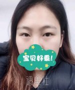 省二院张卓男纪实双眼皮案例：这自然度赶上天生的了 width=