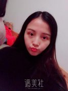 成都华美紫馨谷斌全切双眼皮过程分享|颜值变化的秘密武器 width=