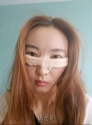 上海九院金云波做眼袋修复手术吗?有案例吗? width=
