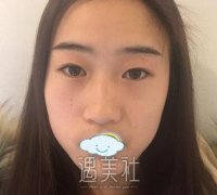 石家庄省二院张卓男双眼皮案例，附恢复过程图~ width=