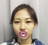 医大二院肖志波双眼皮技术好吗？有案例吗？ width=