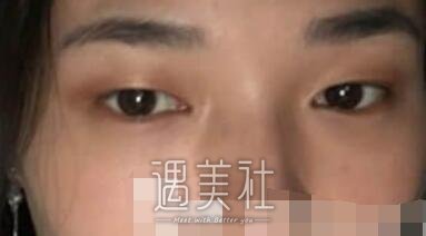 九院,朱惠敏,双眼皮