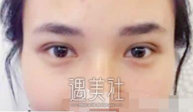 九院,朱惠敏,双眼皮