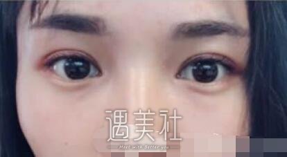 九院,朱惠敏,双眼皮