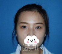 石家庄张卓男双眼皮案例:双眸灵动自然 美丽无懈可击 width=
