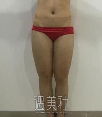 腿部抽脂