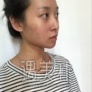 张卓男医生双眼皮技术真的很6?真实案例一览~ width=