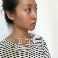 张卓男医生双眼皮技术真的很6?真实案例一览~