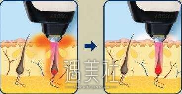 巢湖曙光整形医院脱毛技术好吗?能否一次清理干净?