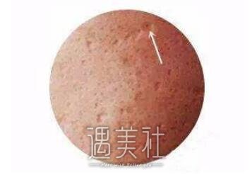 光子嫩肤祛痘印多久能看到果?想了解下~