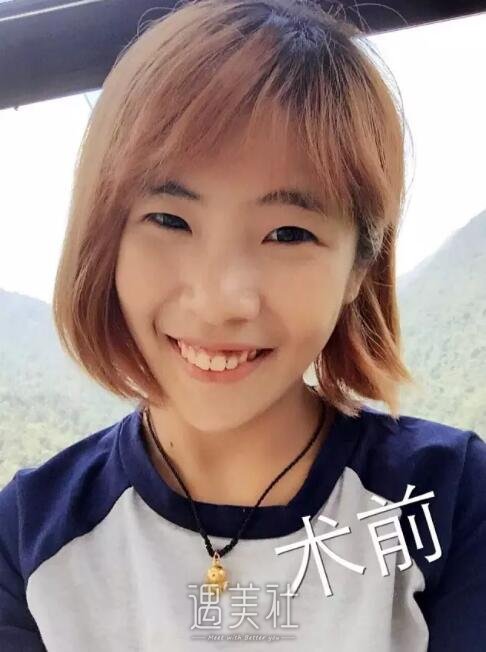 郑东学鼻子案例图|郑东学隆鼻案例真实记录~