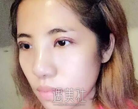 郑东学鼻子案例图|郑东学隆鼻案例真实记录~