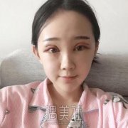 安贞医院李文志双眼皮真实案例分享：大眼睛和小眼睛选择那个? width=