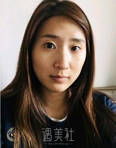 深圳北大医院李天石双眼皮案例