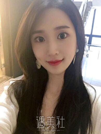 深圳北大医院李天石双眼皮案例
