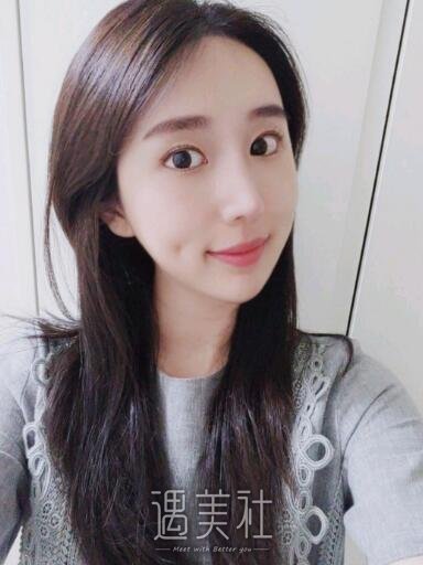 深圳北大医院李天石双眼皮案例