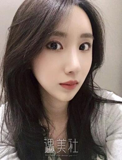 深圳北大医院李天石双眼皮案例