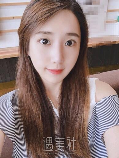 深圳北大医院李天石双眼皮案例