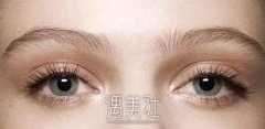 上海欧式全切双眼皮多少钱?有哪些影响因素? width=