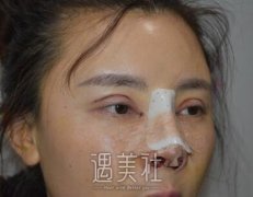 谢卫国鼻子案例：谢医生做鼻子真是一把好手! width=