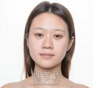 九院李青峰隆鼻案例：无需化妆，也可以清新自然！ width=