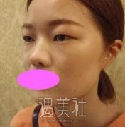 九院王梓双眼皮案例：做了双眼皮，睫毛都上扬了！ width=
