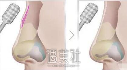 韩式驼峰鼻矫正