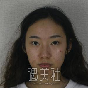 省二院,张卓男,修复双眼皮